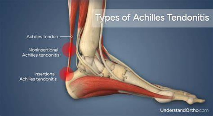 Achilles Tendon Problems and Treatment