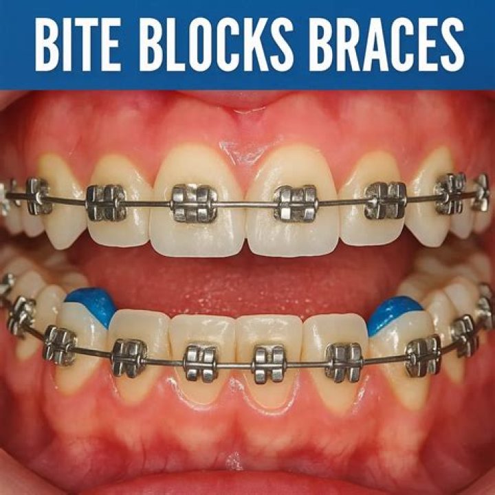 How To Remove Bite Blocks Braces